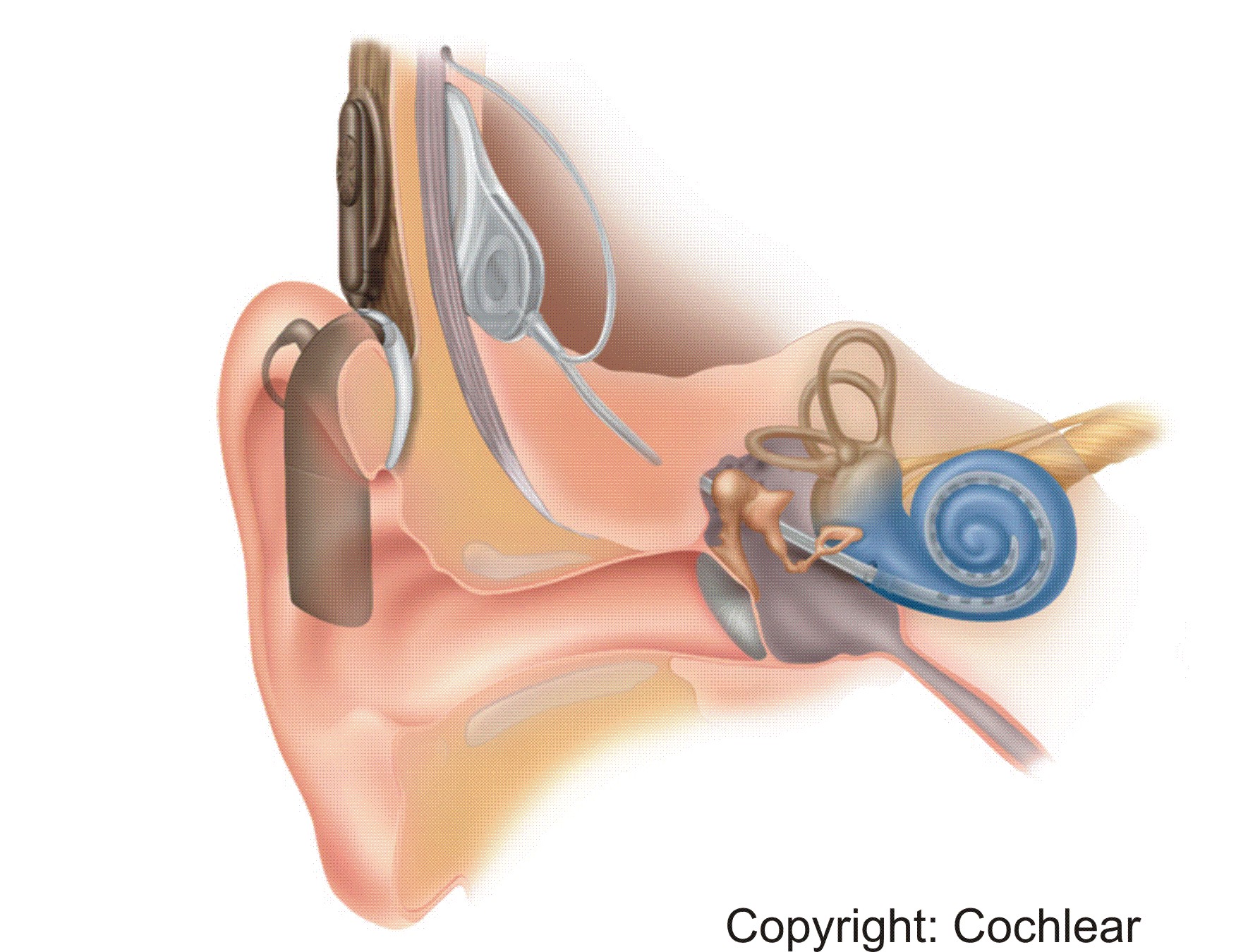 Cochlea implant with an external microphone and micro-speech-processor (illustration copyright: Cochlear)