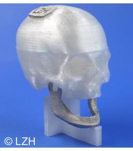 Bild 2: Implantate aus Magnesium können vom Körper abgebaut werden und brauchen so nicht durch einen zweiten operativen Eingriff entfernt zu werden. Foto: LZH
