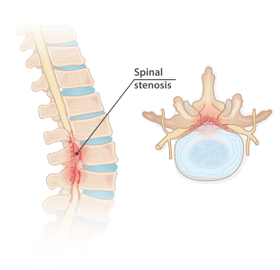 Spinal stenosis